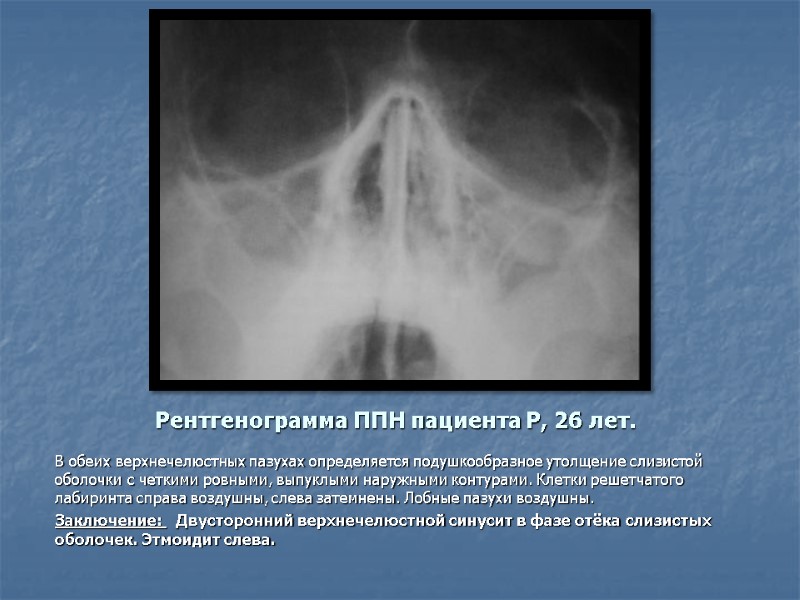Рентгенограмма ППН пациента Р, 26 лет. В обеих верхнечелюстных пазухах определяется подушкообразное утолщение слизистой